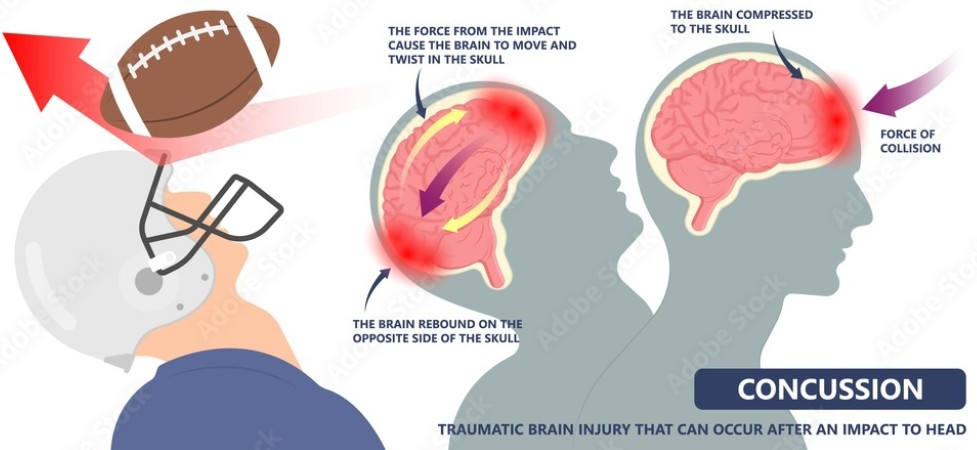 Chicago Concussion Doctor