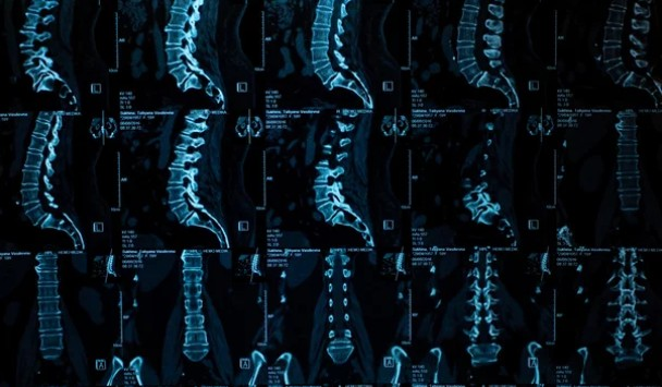 Generative Lumbar Disc MRI