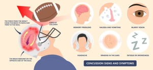 Sports Concussion Signs & Symptoms – Treatment At DRX Chicago