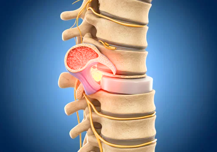 Treatment of Bulging Disk & Back Pain in Chicago