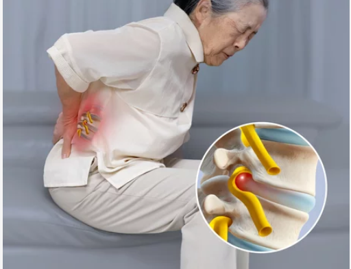 Treatment-of-Buldging-Disks-in-chicago-lakeview