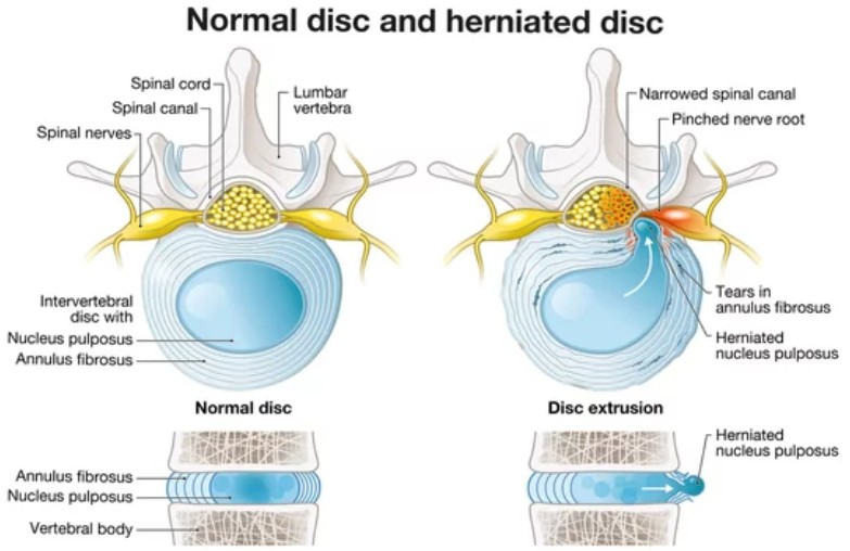 DRX9000 Chicago: Treatment Of Herniated Discs