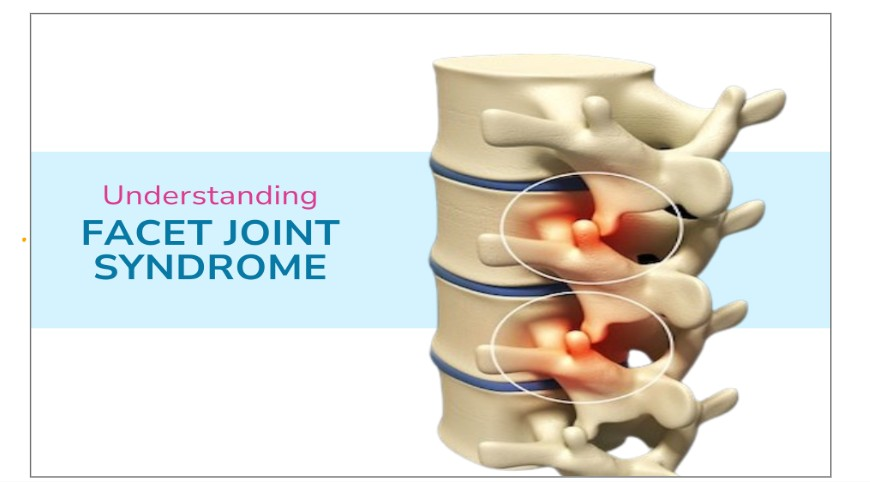 Understanding Facet Joint Syndrome and; Facet Joint Pain