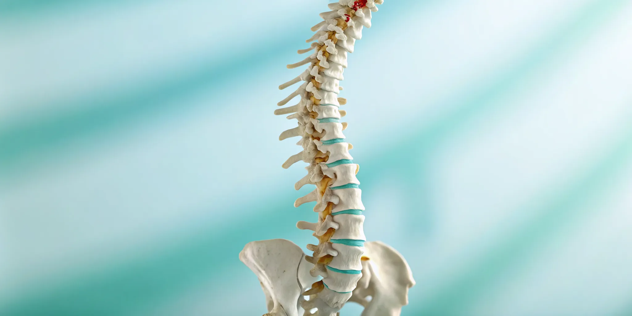 Anatomical model of a human spine with a degenerative spinal disorder.